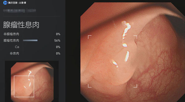 “腾讯觅影” 结直肠肿瘤筛查AI系统实时发现、鉴别息肉